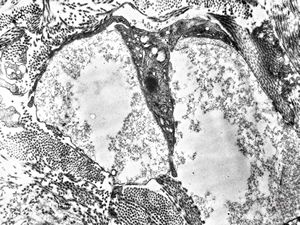 M, 40y. | reticular erythematous mucinosis